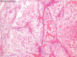 Fig._1-_ISUP_G3_with_clear_and_eos_cytoplasm,_10x300