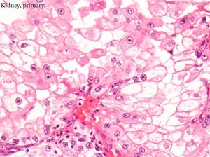 Fig._2_-ISUP_G3_with_clear_and_eos_cytoplasm,_40x300